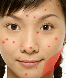 天津哪家医院祛痘比较好